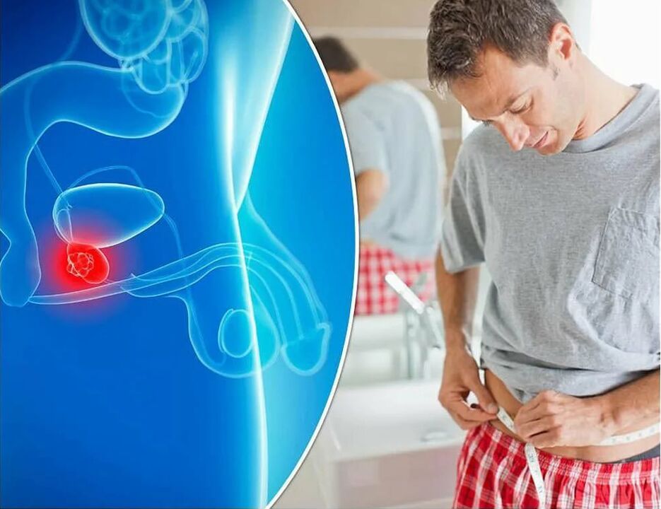 sintomas e causas da prostatite