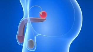 massagem da próstata para a prevenção da prostatite