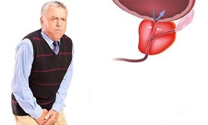 sintomas de prostatite em homens