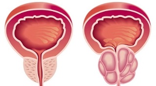 razões para o desenvolvimento de prostatite e adenoma de próstata