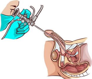 Procedimento de ureteroscopia
